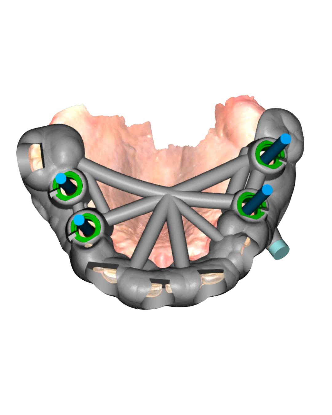 Digital 3D surgical guide design preview