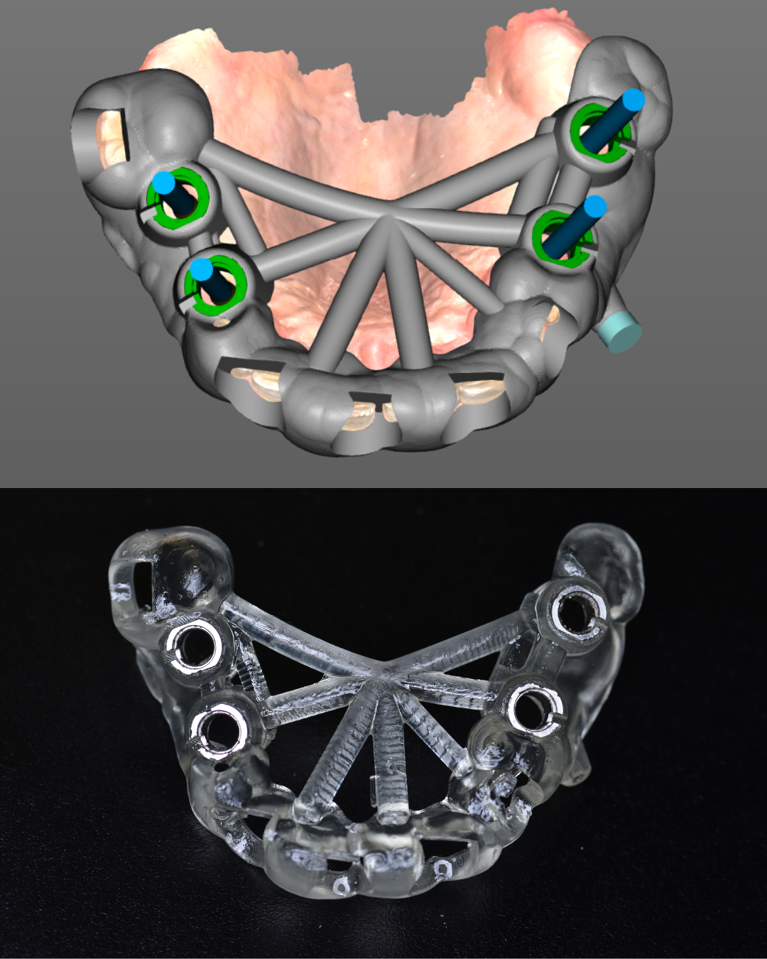 Digital CAD design of a full-arch stackable surgical guide with implant analogs shown next to its 3D-printed clear resin counterpart