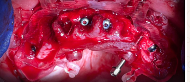Intraoperative surgical guide — stackable system bottom view
